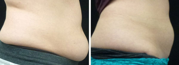 coolsculpting results on abdomen