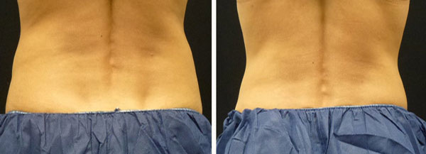 coolsculpting results on back