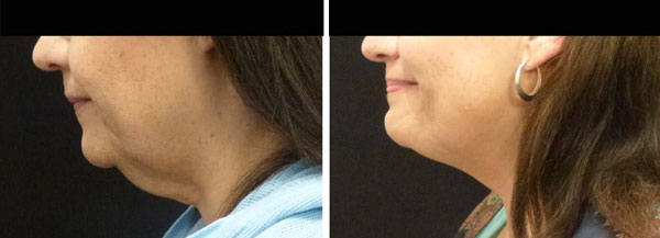 coolsculpting results on neck